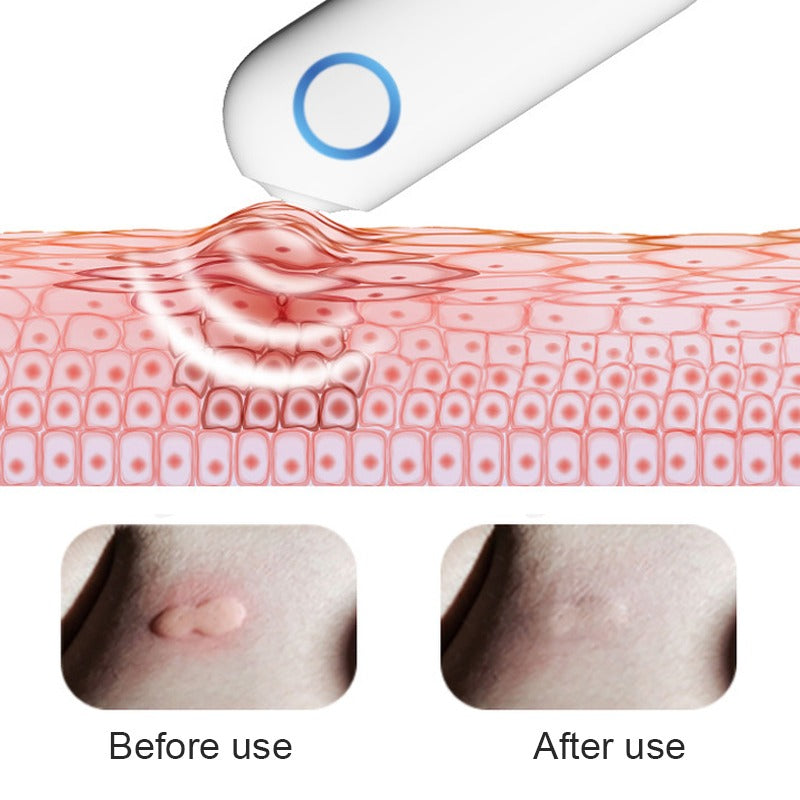 Portable Anti-Itch Device Insect Bite Healer – Rechargeable Mosquito Bite Relief for Outdoor Use