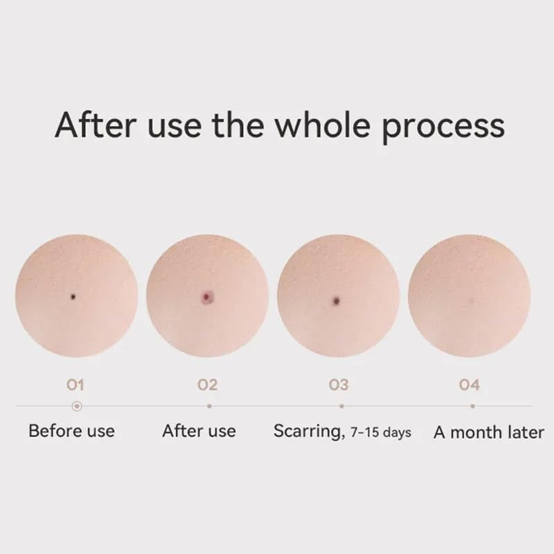 Plasma Mole Skin Tag & Spot Remover Pen – Multi-Speed LCD Laser Tool for Skin Care