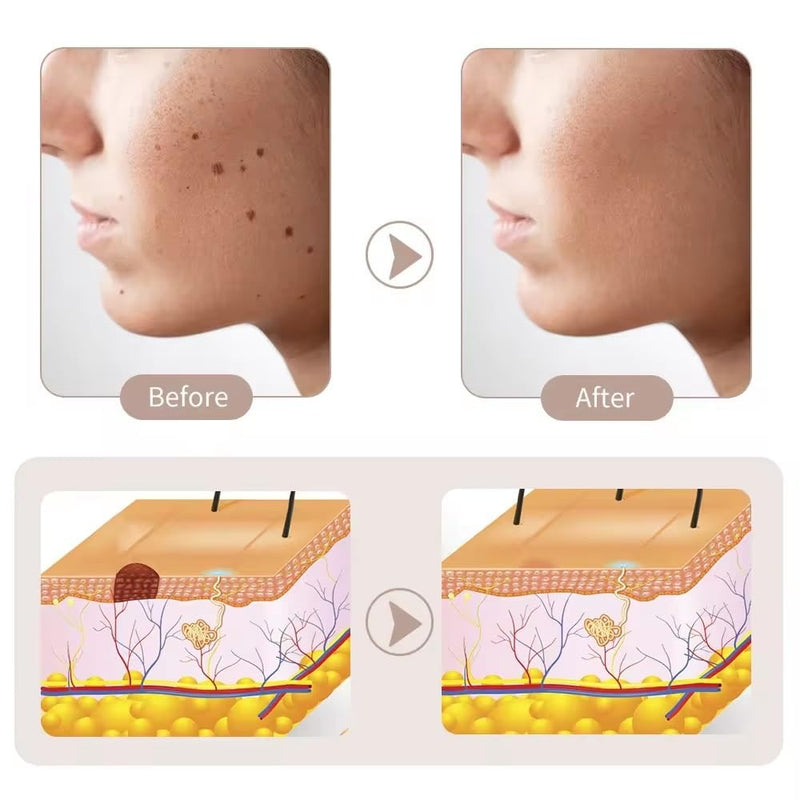 Plasma Mole Skin Tag & Spot Remover Pen – Multi-Speed LCD Laser Tool for Skin Care