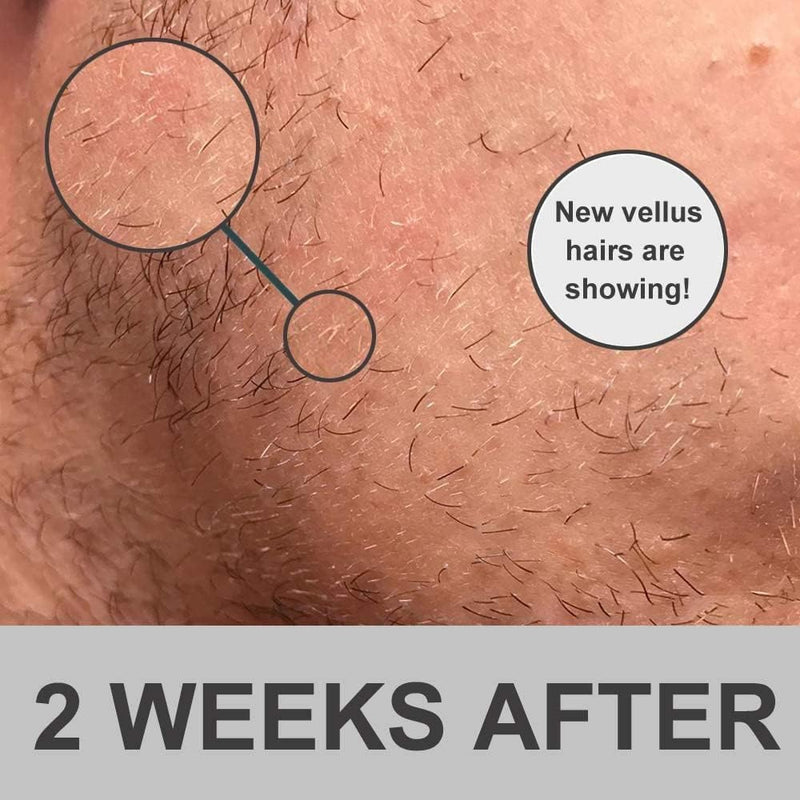 Derma Roller – Microneedle Roller for Face Beard & Scalp